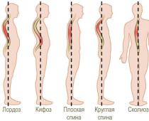 Нарушение осанки у детей Общеразвивающие упражнения при нарушениях осанки